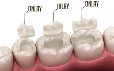 20 benefícios da restauração, obturação ou bloco Inlay e Onlay para seus dentes