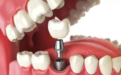 20 benefícios e vantagens do implante dentário