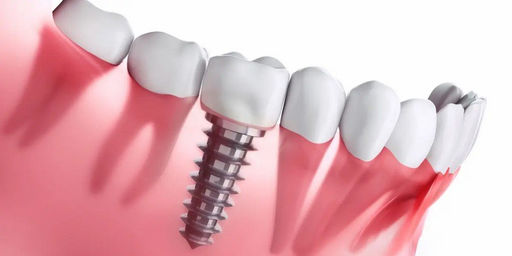 Descubra Quanto Custa um Implante Dentário e as Vantagens do Plano com Implantes